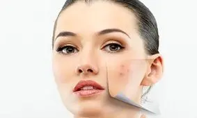 جلوگیری از جوش صورت در تابستان