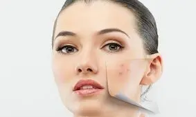 جلوگیری از جوش صورت در تابستان