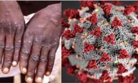 احتمال ابتلا به آبله میمونی قبل از بروز علائم