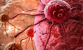 علائم ۳ سرطان شایع و روش‌های پیشگیری از آن ها