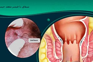 در مورد شقاق یا فیشر مقعد چه می‌دانید؟