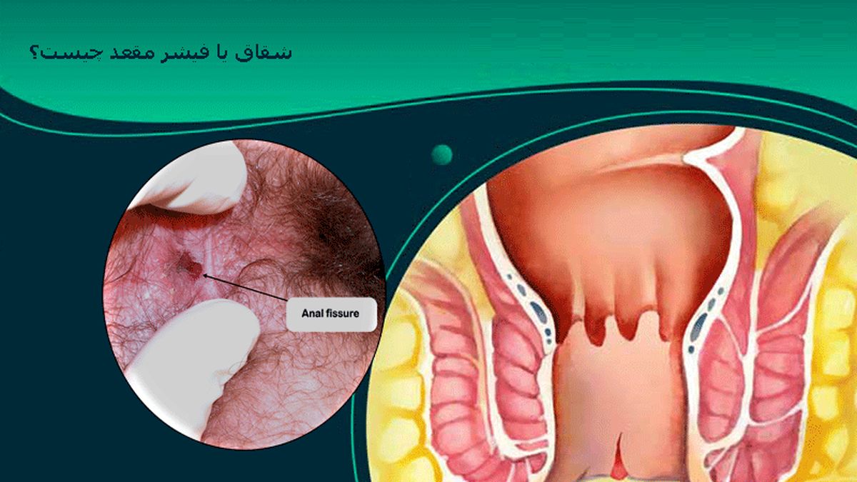 در مورد شقاق یا فیشر مقعد چه می‌دانید؟