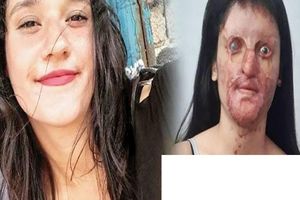 ازدواج جنجالی دخترجوان با عامل اسیدپاشی روی صورتش