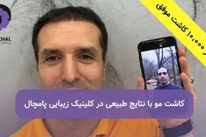 تهران، رکورد کاشت مو رو زد! 