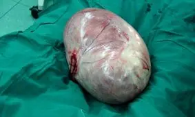 خارج کردن تودۀ ۱۱ کیلویی از شکم یک بیمار/ ویدئو