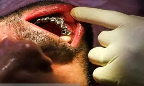 شیوع بی‌دندانی در ایران پس از ۳۵ سالگی

