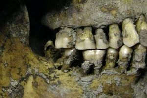 چرا وایکینگ ها همگی پوسیدگی شدید دندان داشتند؟