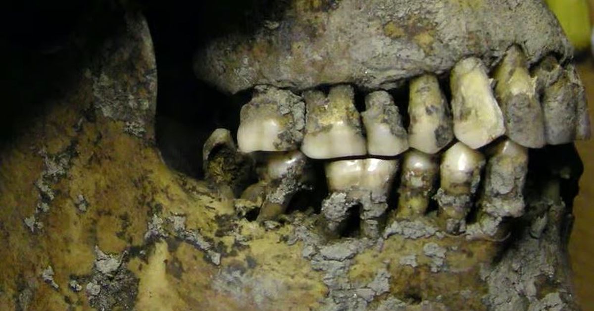 چرا وایکینگ ها همگی پوسیدگی شدید دندان داشتند؟