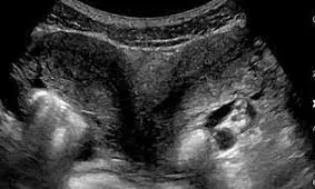 زن آمریکایی در هر دو رحم خود باردار شد