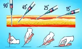 آموزش تصویری آمپول زدن به پشت
