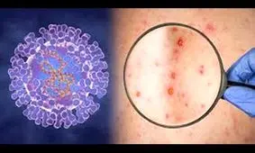 شمار مبتلایان به آبله میمونی در انگلیس به ۴۷۰ نفر رسید