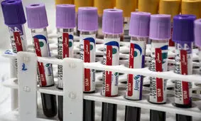 بی‌تحرکی در بستری‌ها مهمترین دلیل لخته شدن خون است

