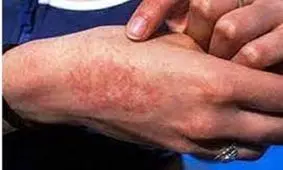 ابتلای ۳۰۰۰ نفر به تب مالت از ابتدای سال