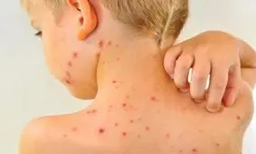 مهمترین علامت ابتلا به سرخک