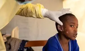 اعلام وضعیت اضطراری در پی شیوع آبله میمونی

