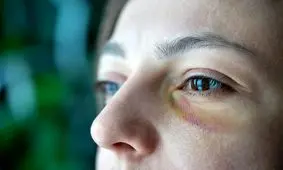 «چشم راکونی» چیست؟