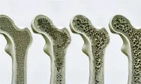 کشفی که می‌تواند درمان پوکی استخوان را متحول کند

