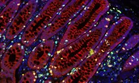 کشف نقشه‌ راه برای غلبه بر سرطان روده

