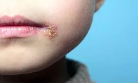 درمان جدیدی برای تبخال در دانشگاه قزوین کشف شد