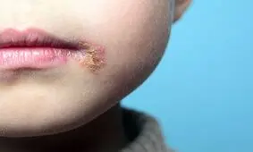 درمان جدیدی برای تبخال در دانشگاه قزوین کشف شد