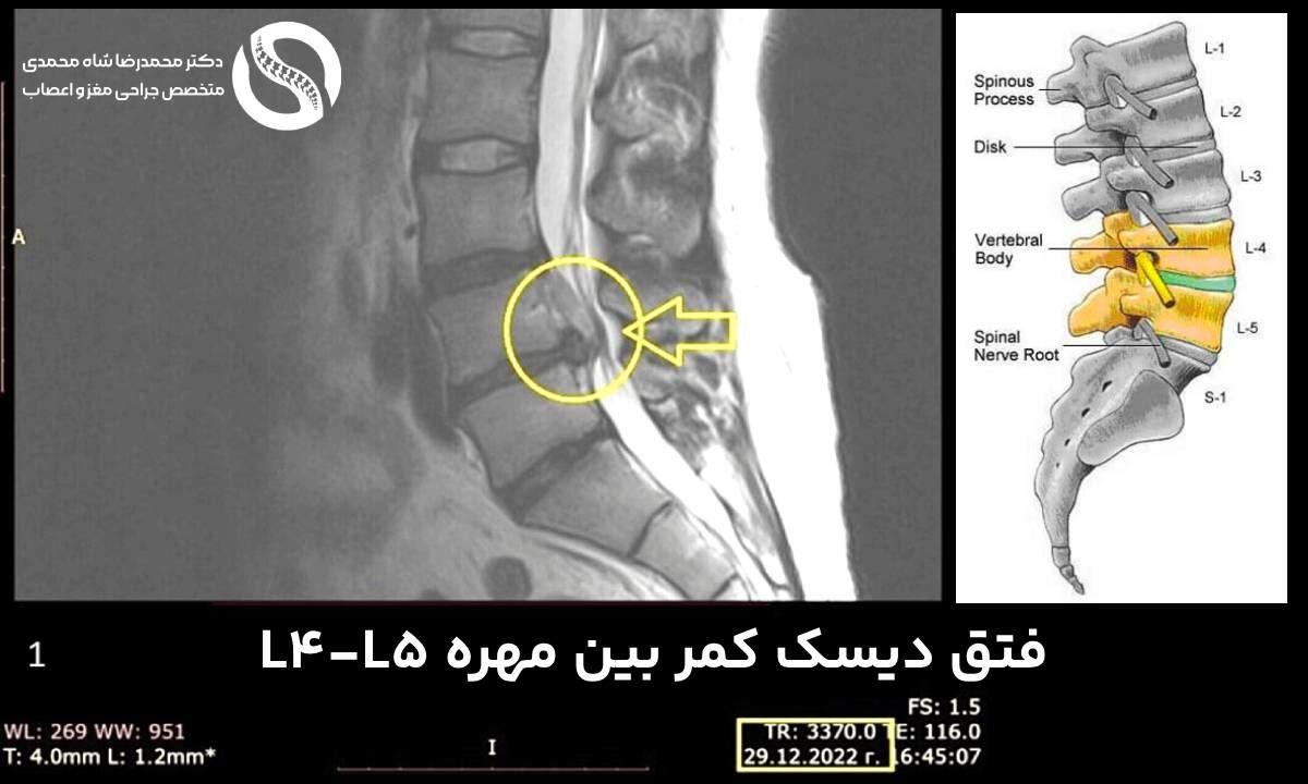 نمونه تصویر MRI از فتق دیسک کمر بین مهر L4-L5 در یک بیمار - دکتر شاه محمدی