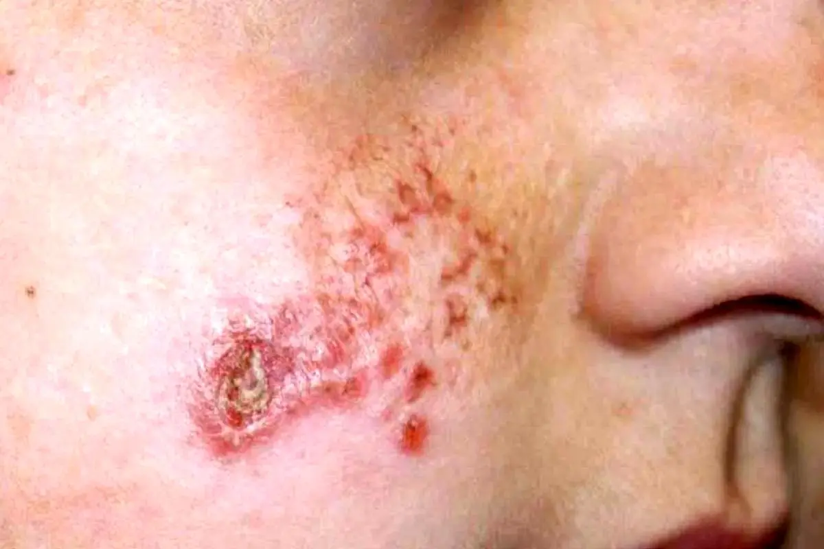 هشدار درباره شیوع ‌انگل‌ خطرناک لیشمانیوز