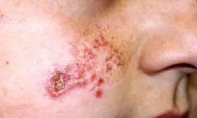 هشدار درباره شیوع ‌انگل‌ خطرناک لیشمانیوز