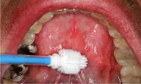 تشخیص سرطان دهان با یک برس کوچک

