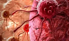 خطر ابتلا به سرطان تخمدان در آرایشگران و حسابداران بیشتر است