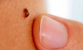 علامت مهم خال سرطانی