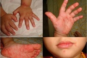 یک بیماری جدید به اسم «دست،‌ پا و دهان» شیوع پیدا کرده؟/ توضیحات یک متخصص
