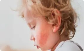 چرا اگزما اغلب در کودکی شروع می‌شود؟
