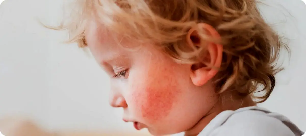 چرا اگزما اغلب در کودکی شروع می‌شود؟
