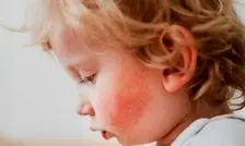 چرا اگزما اغلب در کودکی شروع می‌شود؟
