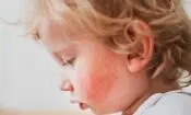 چرا اگزما اغلب در کودکی شروع می‌شود؟
