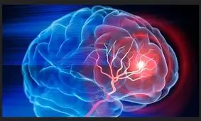 علت افزایش موارد ابتلا به سکته مغزی در جهان چیست؟