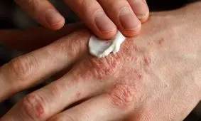 دیابت چگونه بر پوست تاثیر می‌گذارد؟