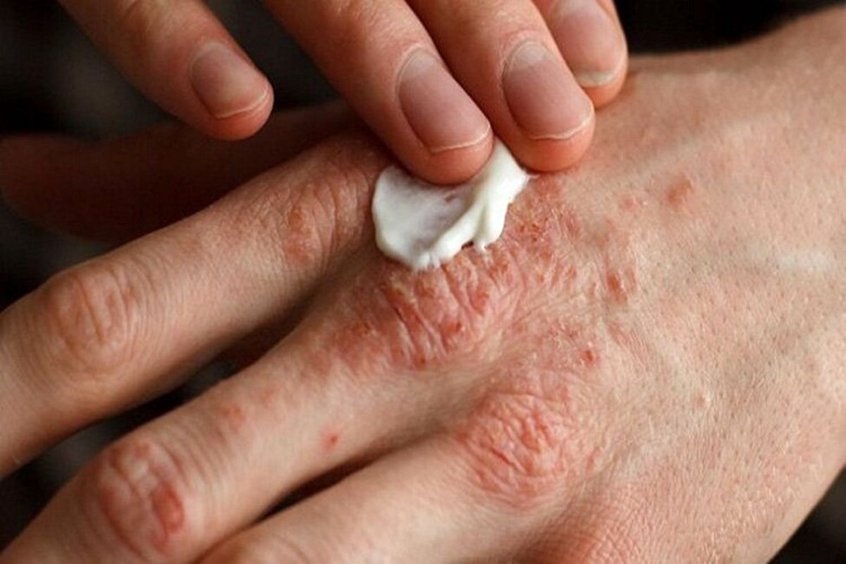 دیابت چگونه بر پوست تاثیر میگذارد؟
