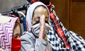 امتناع شرکت سوئدی از فروش پانسمان برای کودکان پروانه ای ایران