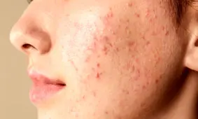 چرا جوش می‌زنیم؟