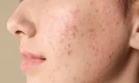 چرا جوش می‌زنیم؟