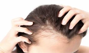 ویتامینی که کمبود آن سبب ریزش مو می‌شود