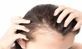 ویتامینی که کمبود آن سبب ریزش مو می‌شود