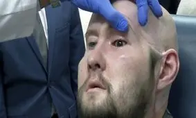 نخستین پیوند چشم کامل در جهان انجام شد/ ویدئو