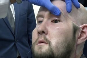 نخستین پیوند چشم کامل در جهان انجام شد/ ویدئو