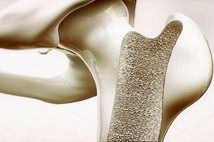 کمک هورمون درمانی به پیشگیری از پوکی استخوان