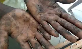 تاثیر آب و هوا بر وخیم شدن بیماری های پوستی