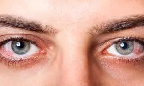 ۵ ماده مغذی برای جوان ماندن چشم/ اینفوگرافیک