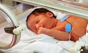 علت تولد پیش از موعد نوزادان در ایران چیست؟