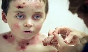 پدر یک کودک پروانه ای: 10 میلیون پول آزمایش غربالگری را از کجا بیاورم؟